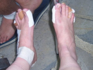 bandaged feet Santiago